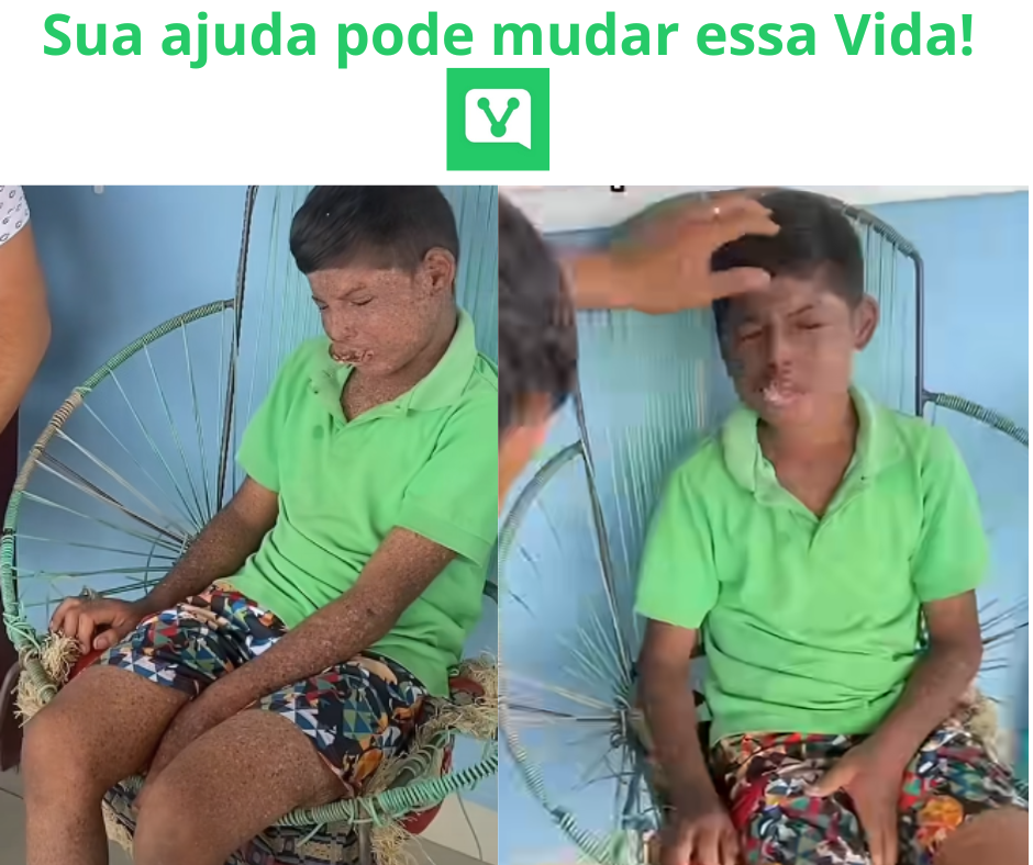 Markinho Lima, 12 anos, sofrendo com câncer nos lábios em São Paulo